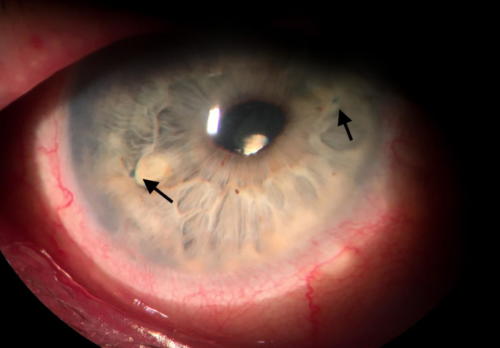Artificial intraocular lens - iris fixation